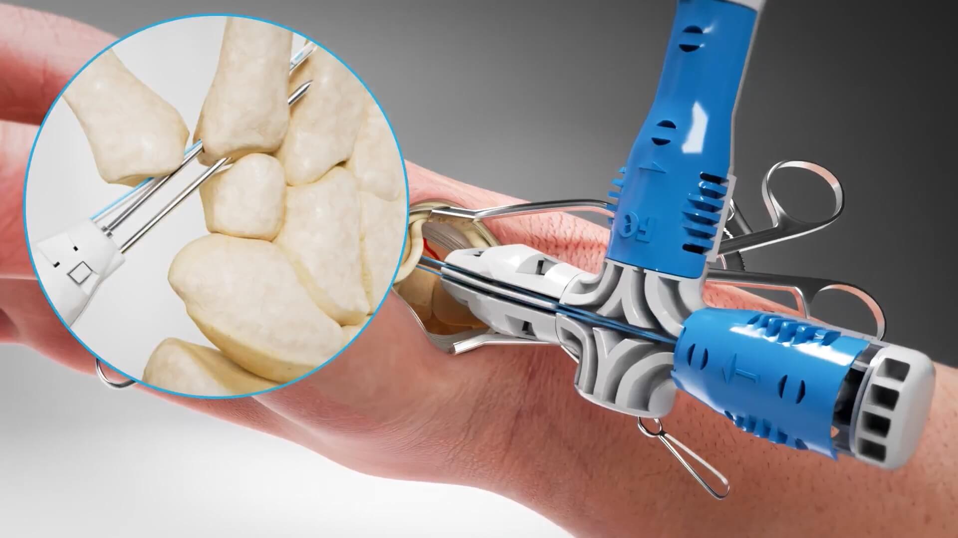 Field Orthopaedics - 3D animation of surgical technique 1